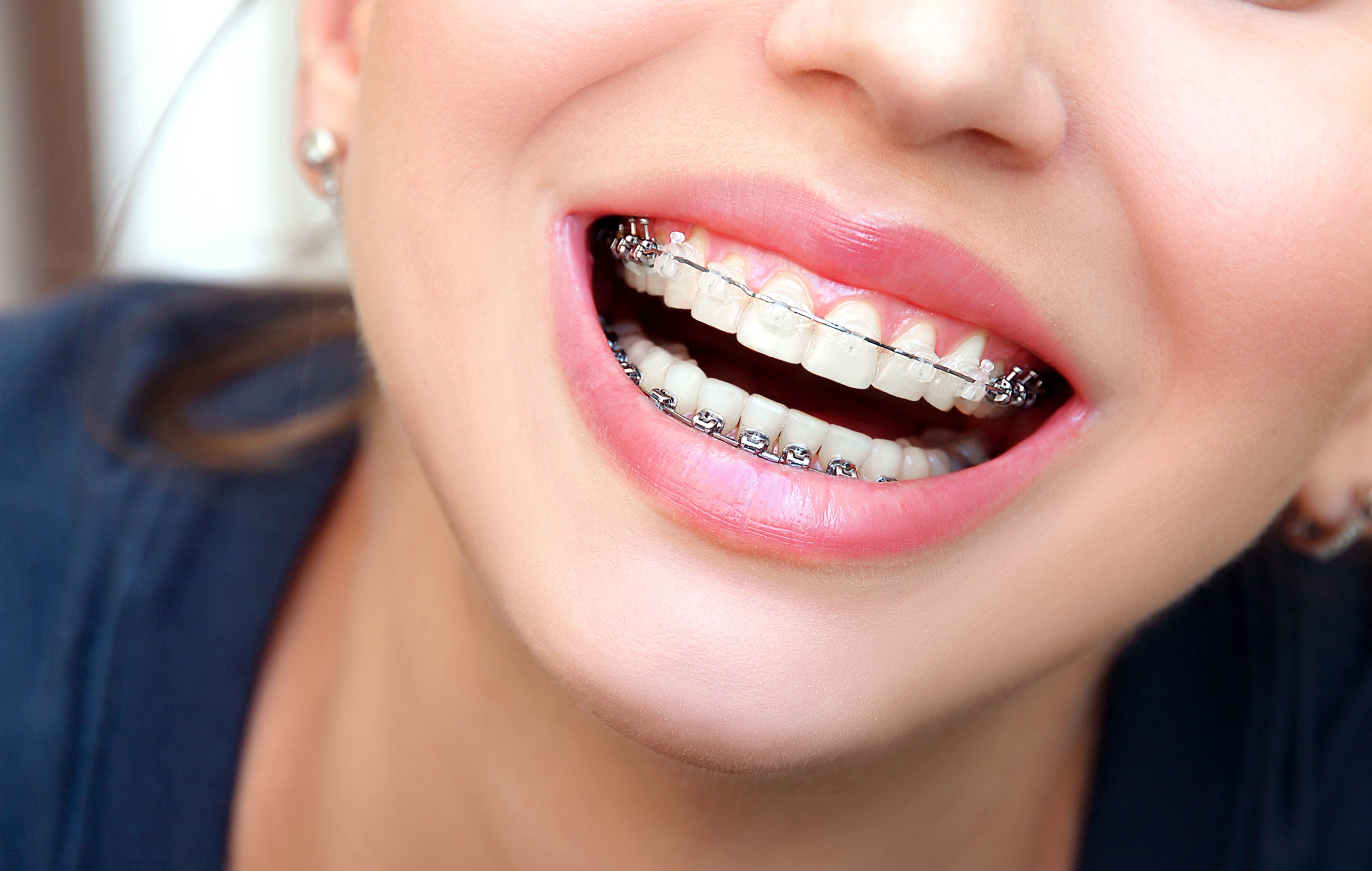 A closeup of a caucasian girl's clear ceramic orthodontic braces as she smiles.