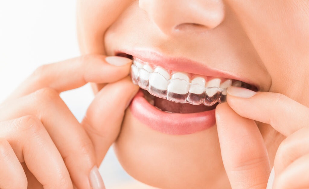 Why You Should Choose to be Treated by an Orthodontist over your Dentist for you Orthodontic Needs, Including Braces, Invisalign, and other Clear Aligner Treatments